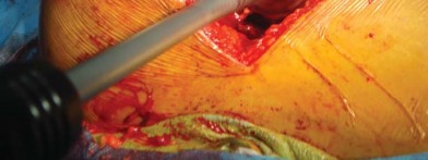 Illustration 55 for The Silent Hip: Achieving a Truly Silent, Pain-Free Joint