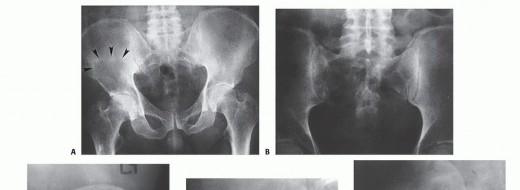 Illustration 3 for Surgical Pelvic Resection: Gluteus Maximus Muscle & Nerve Preservation