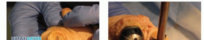 Illustration 66 for End Articular Cartilage Loss: Arthrosurface HemiCAP Resurfacing