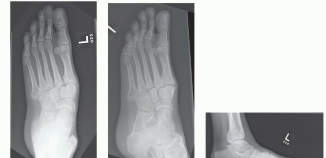 Illustration 70 for Mastering Midfoot Arthrodesis: Protect the Deep Neurovascular Bundle