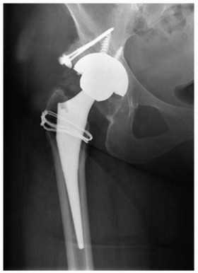 Illustration 4 for Sliding Trochanteric Osteotomy: Modern Role & Refined Techniques