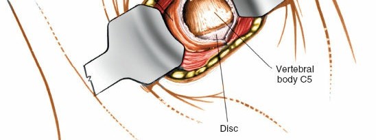 Illustration 256 for Approach to the Lumbar Spine: Mastering Techniques & Anatomy