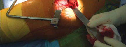 Illustration 52 for Successful Total Hip Replacement in Developmental Dysplasia