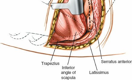 Illustration 313 for Approach to the Lumbar Spine: Mastering Techniques & Anatomy