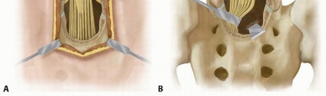Illustration 16 for Mastering High-Grade Spondylolisthesis: Posterolateral and Interbody Fusion