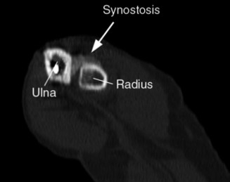 Illustration 3 for Distal Biceps Tendon Injury: Crucial Steps for Optimal Diagnosis & Care