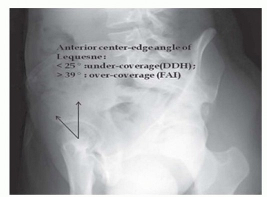 Illustration 6 for Anterior FAI Relief: Mini-Open Anterior Approach Explained