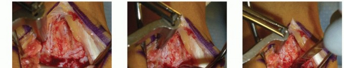 Particulated Juvenile Cartilage for Talus Lesions: A Simpler Path