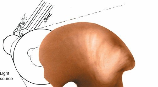 Illustration 2 for Pelvis & Acetabulum Approaches: Unlocking the Posterior Superior Iliac