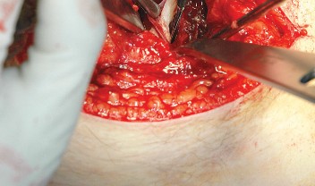 Illustration 41 for Unlock the Figure Posterior Approach to the Hip