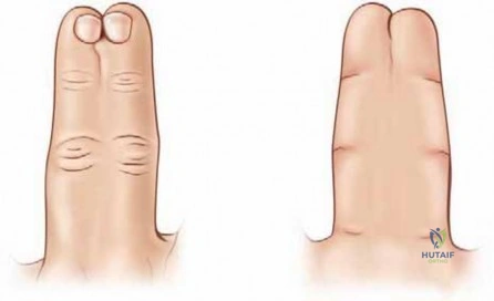 Radial Styloidectomy: Indications, Biomechanics, and Surgical Technique