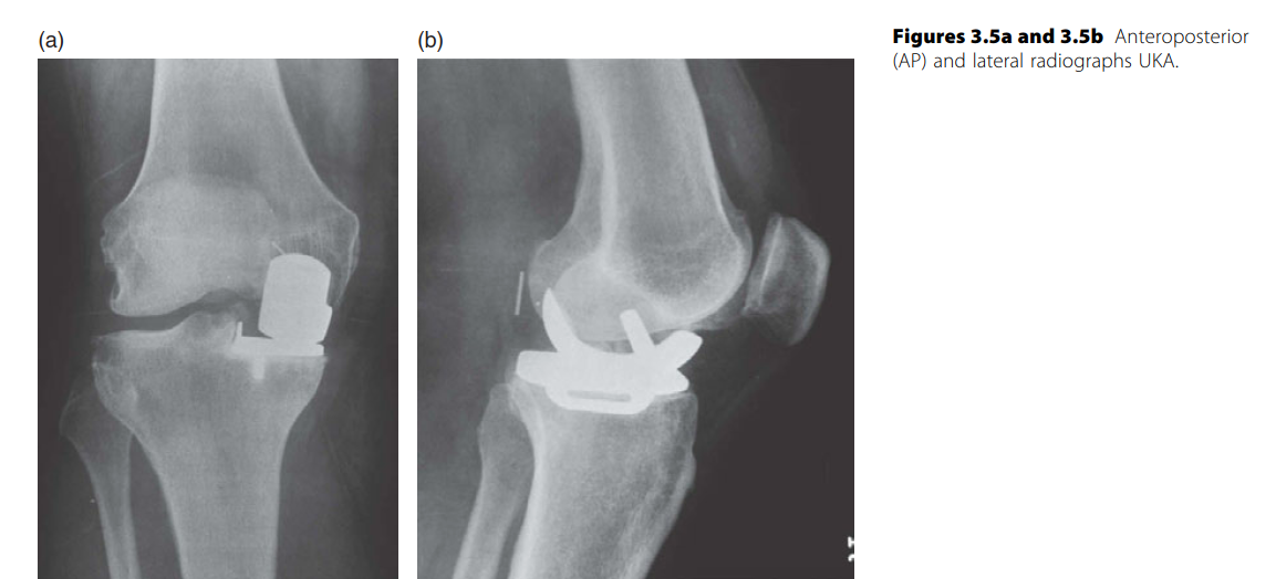 UKA Versus Total Knee Replacement: Pros, Cons, & Your Decision Guide