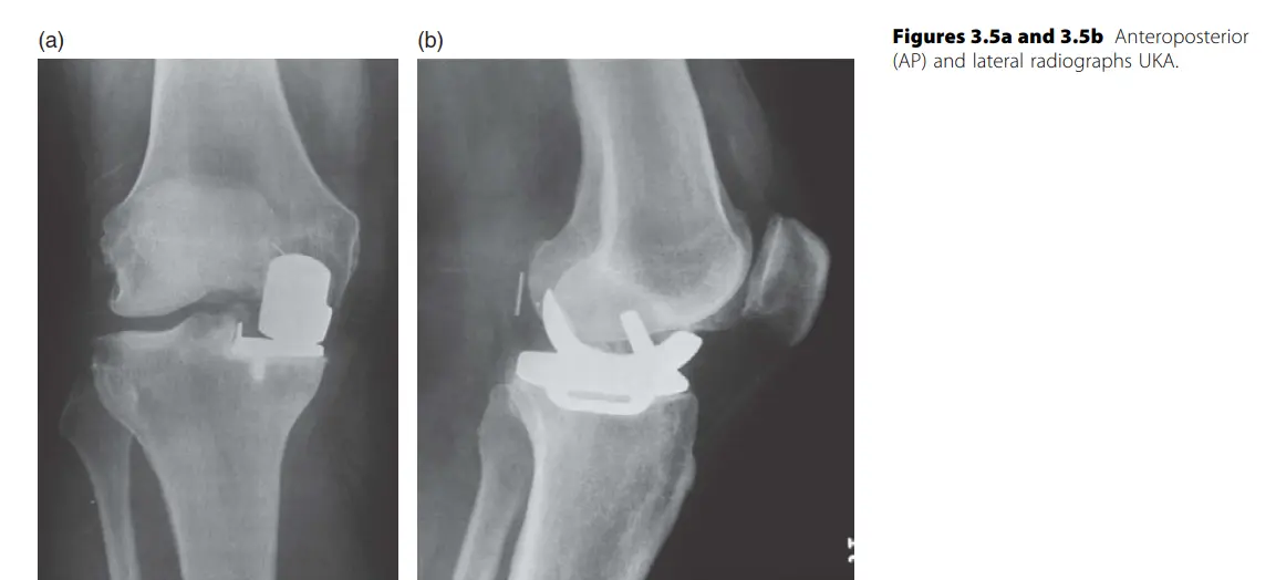 مفصل الركبة الجزئي (UKA) مقابل مفصل الركبة الكلي (TKA): دليلك الشامل لاتخاذ القرار