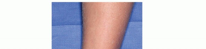 Arthroscopy of the Ankle: Your Guide to Minimally Invasive Treatment