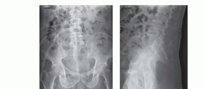 Illustration 57 for Sacral Tumor Surgery: Safeguarding Bowel & Bladder Control