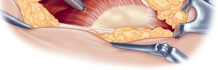 Illustration 40 for Direct Lateral Hip: Optimize Exposure with Sharp Curved Hohmann
