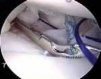 Illustration of traumatic anterior instability - Dr. Mohammed Hutaif