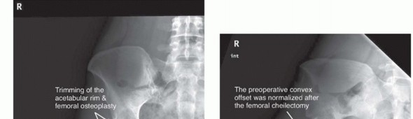 Illustration 4 for Anterior FAI Relief: Mini-Open Anterior Approach Explained