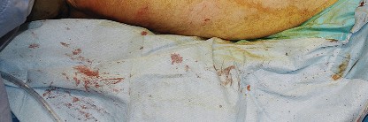 Illustration 61 for Unlock the Figure Posterior Approach to the Hip