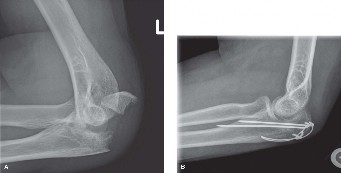 Illustration of tension band wire - Dr. Mohammed Hutaif