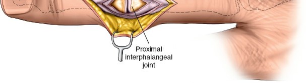 Illustration 6 for Unlock Easier Access: Dorsal Approach for Phalanges and Interphalangeal Joints