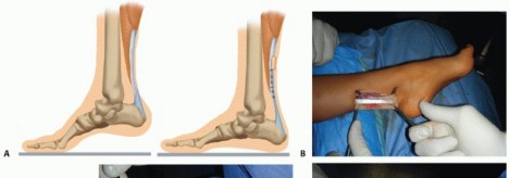 Illustration 39 for How Achilles Tendon Lengthening Fixes Equinocavovarus Foot