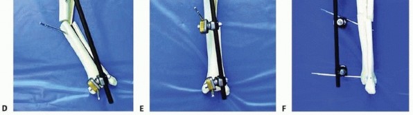 Illustration 29 for Tibia External Fixation: See How Pins Are Placed for Healing