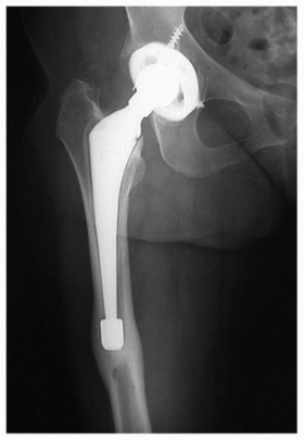 Illustration 8 for Mastering Revision THA: Strategies for Adverse Local Tissue Challenges