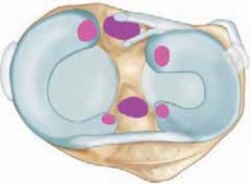 Knee Arthroscopy: What the Horn of the Medial Means