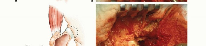 Illustration 14 for Mastering Femoral Metastases: Optimal Function for Femoris & Vastus
