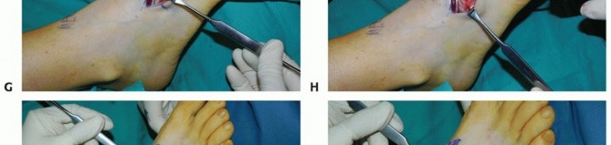 Illustration 25 for Mastering Midfoot Arthrodesis: Protect the Deep Neurovascular Bundle