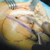 Illustration 7 for Knee Arthroplasty Unicondylar: Discover if Partial Knee Replacement is Right