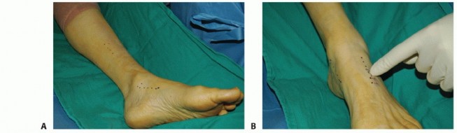 Illustration 25 for Restore Movement: Tendon Transfer for Common Peroneal Nerve Foot Drop