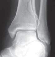 Illustration 13 for Optimizing ORIF for Tibial Plafond Fractures: A Modern Approach