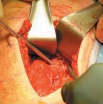 Illustration of hamstring injury proximal hamstring - Dr. Mohammed Hutaif