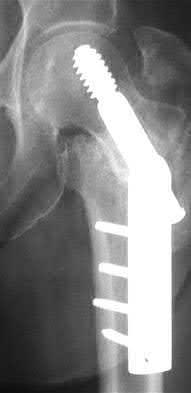 Illustration 50 for OrthoCash: Trauma MCQs & Cases for a yearold woman