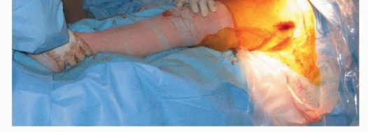 Illustration 37 for Hemiarthroplasty of the Hip: Indications & Types Explained