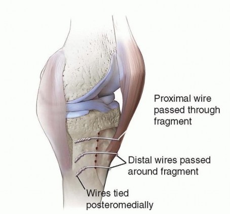 Illustration 11 for Tibial Tubercle Osteotomy: The Key to Extensile Exposure in Revision TKA