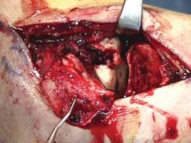 Illustration 15 for Talar Neck Fracture Treatment: Optimizing Recovery with ORIF