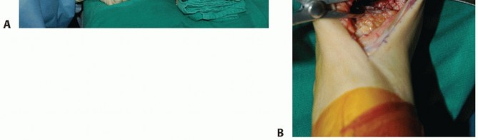 Illustration 18 for Optimize Pain Management with Proximal Ring Block for Ankle Arthrodesis