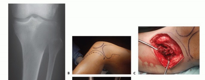 Illustration 15 for Avoid Major Surgery: Bone Tumor Treatment with Liquid Nitrogen Pour