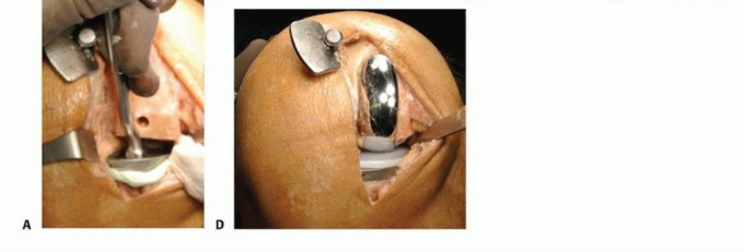 صورة طبية: استبدال مفصل الركبة الجزئي: حل متقدم لآلام الركبة المستمرة مع الأستاذ الدكتور محمد هطيف