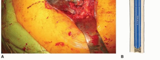 Illustration 17 for Recreate Hip Biomechanics: Modular Stems for Modular Solutions