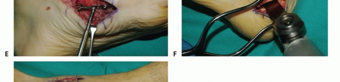 Illustration 80 for Mastering Midfoot Arthrodesis: Protect the Deep Neurovascular Bundle