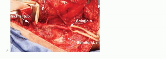 Illustration 23 for Posterior Thigh Resection: Rethinking Outcomes & Limb Sparing