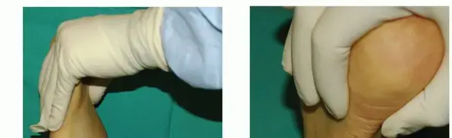 صورة توضيحية لـ علاج سقوط القدم بالأوتار: استعيدوا خطواتكم بثقة مع الدكتور محمد هطيف