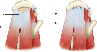 Illustration 2 for Irreparable Rotator Cuff Tears: What Are Your Treatment Options?