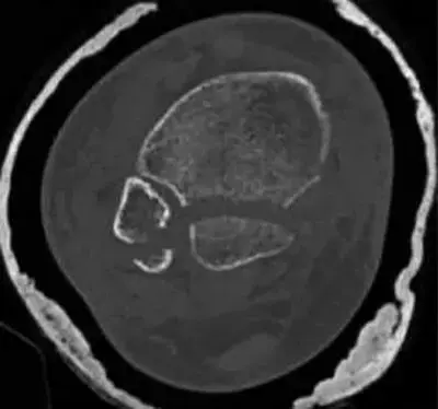 الإصابات العظمية المعقدة وجراحة الحوادث: دليل شامل من الأستاذ الدكتور محمد هطيف في صنعاء