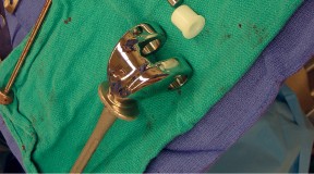 Illustration 52 for Hinged Total Knee: The Salvage Solution for Challenging Cases
