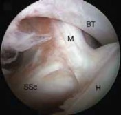 Illustration 5 for Arthroscopic Subscapularis Repair: The lo iky brady Method for Stability